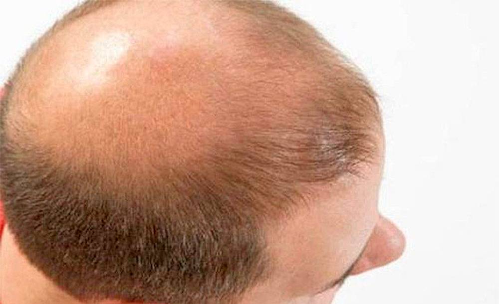 Consejos para poner fin a la alopecia.