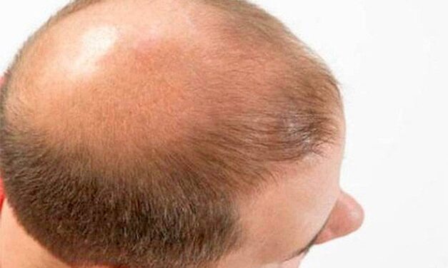 Consejos para poner fin a la alopecia.