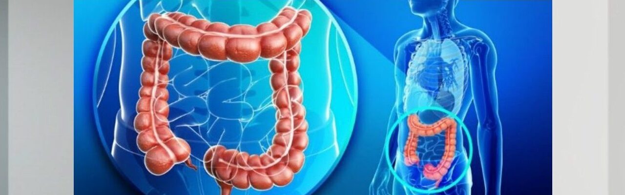 Cáncer de colon: cuáles son los factores de riesgo